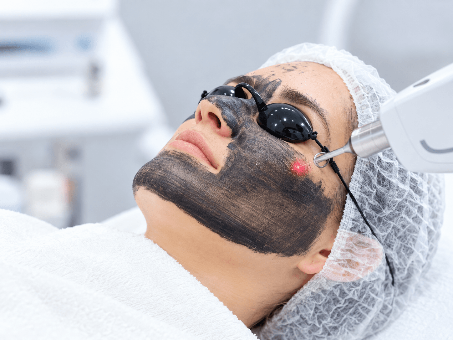 Carbon Peel
