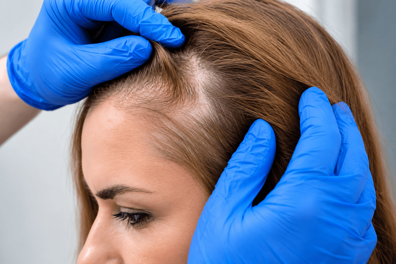 Hair Loss Treatment