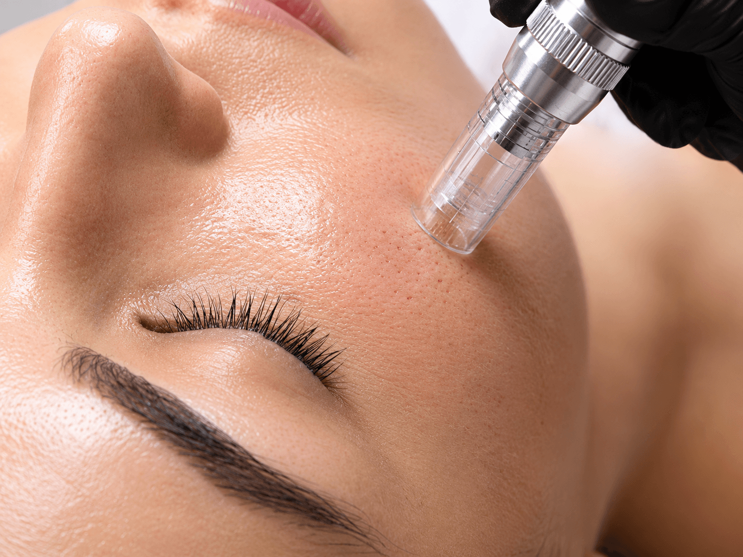 Microneedling