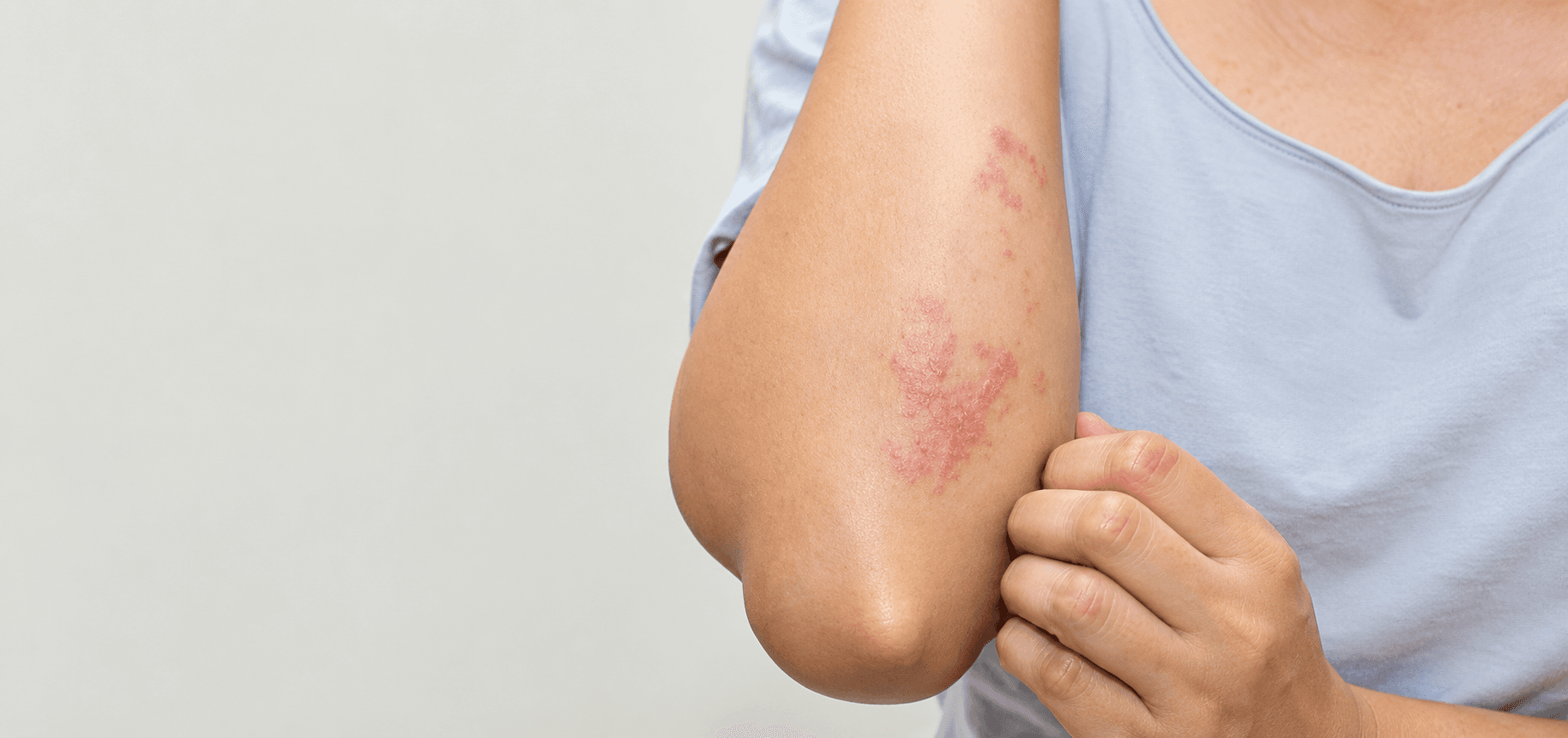 Skin Allergy Treatment